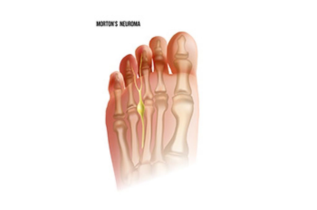 Morton’s Neuroma and Forefoot Pain