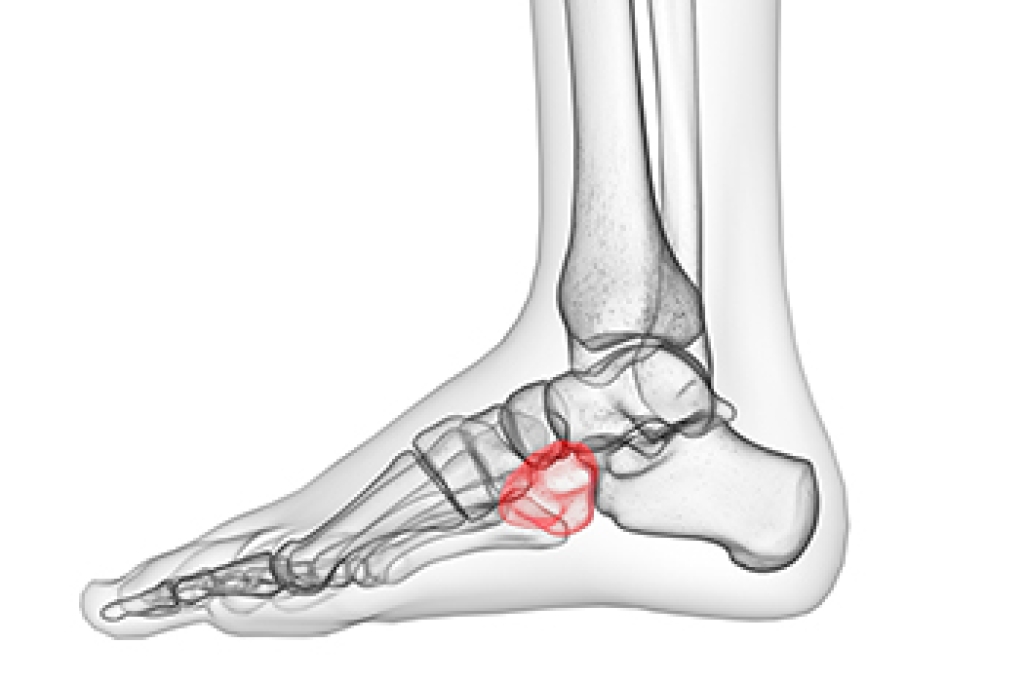 Cuboid Injuries and Foot Pain