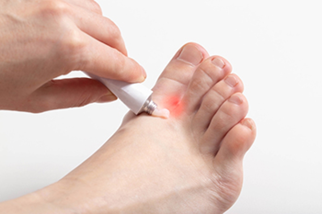 Athlete’s Foot Explained
