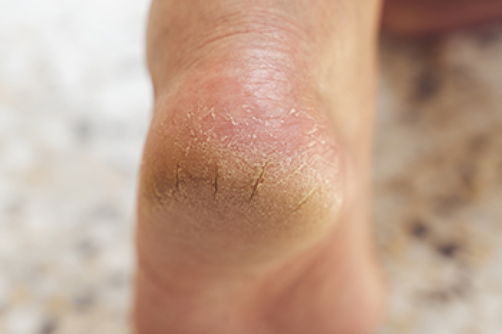 Cracked Heels and Foot Health Care