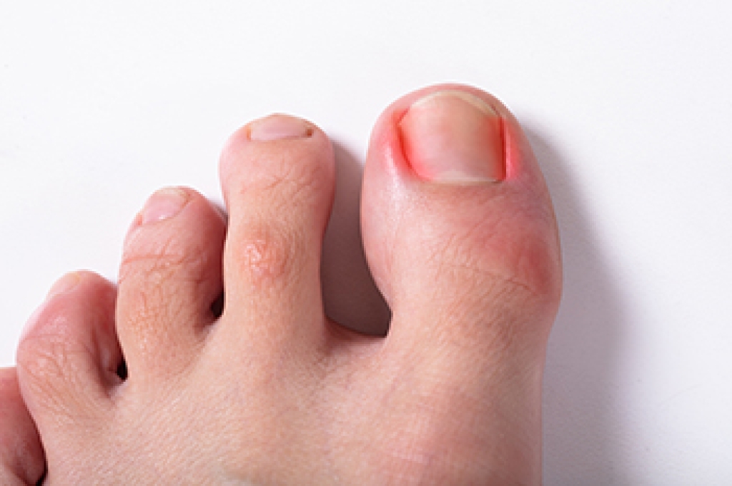 Causes and Stages of an Ingrown Toenail