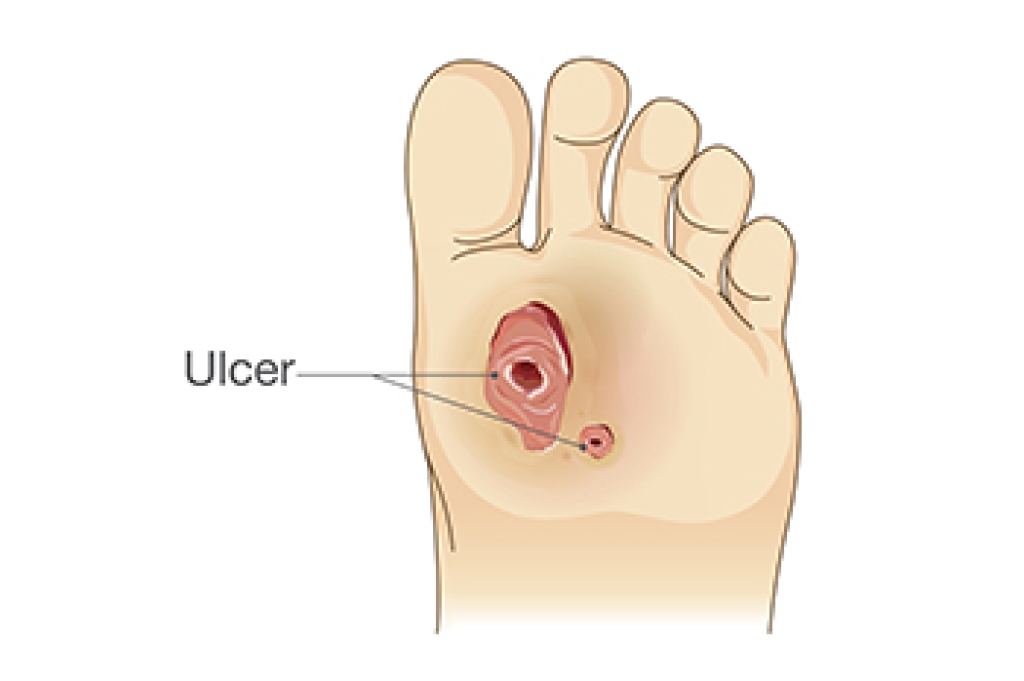 Diabetic Foot Ulcers and the Role of Antibiotics