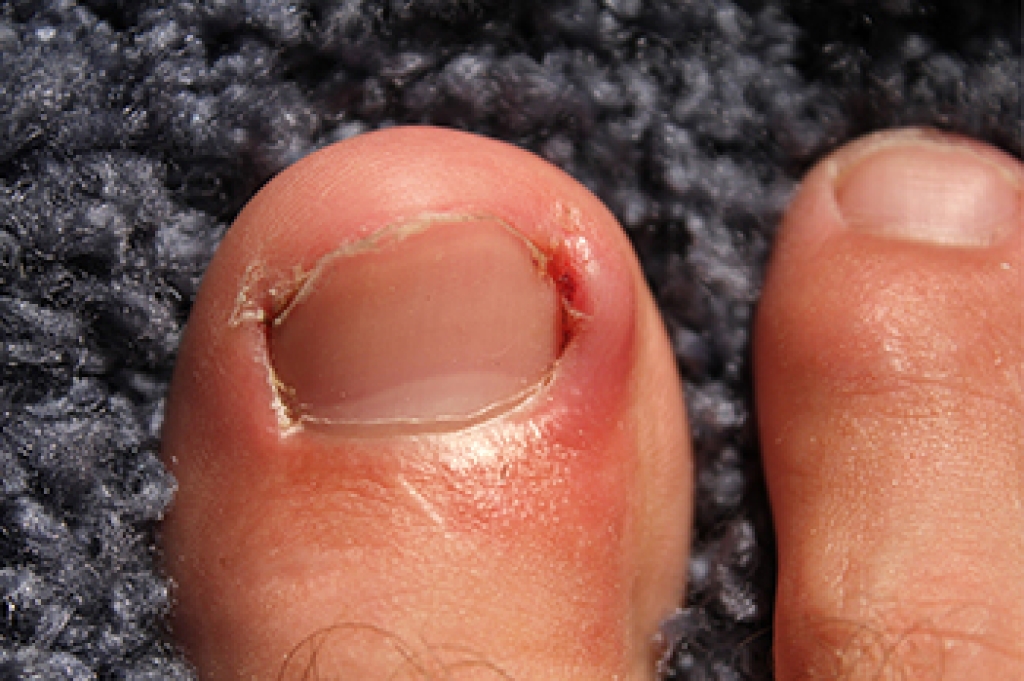 Ingrown Toenail Treatment and Symptoms