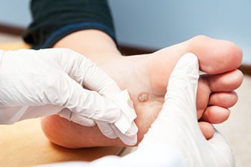 Plantar Warts and Podiatric Treatment