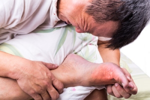 Gout Is Caused by Genetic Reasons or From Specific Foods